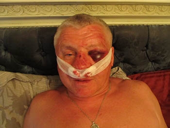 В сети появилось фото избитого лидера запорожского «Правого сектора» фото