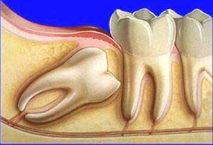 Удаление зубов мудрости. Особенности процедуры. фото