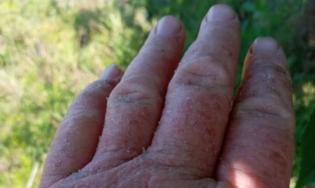 Руки покраснели, кожа слезла: на сборе черешни в Мелитополе женщина заработала химический ожог фото